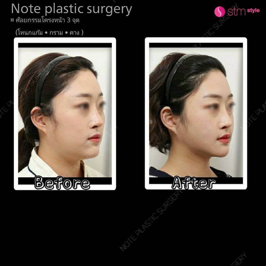 ศัลยกรรมโครงหน้า 3 จุด โรงพยาบาล NOTE รีวิวปรับโครงหน้าเกาหลี ศัลยกรรมโครงหน้า STMstyle เอเจนซี่ศัลยกรรมเกาหลี ลดโหนกแก้ม กราม คาง