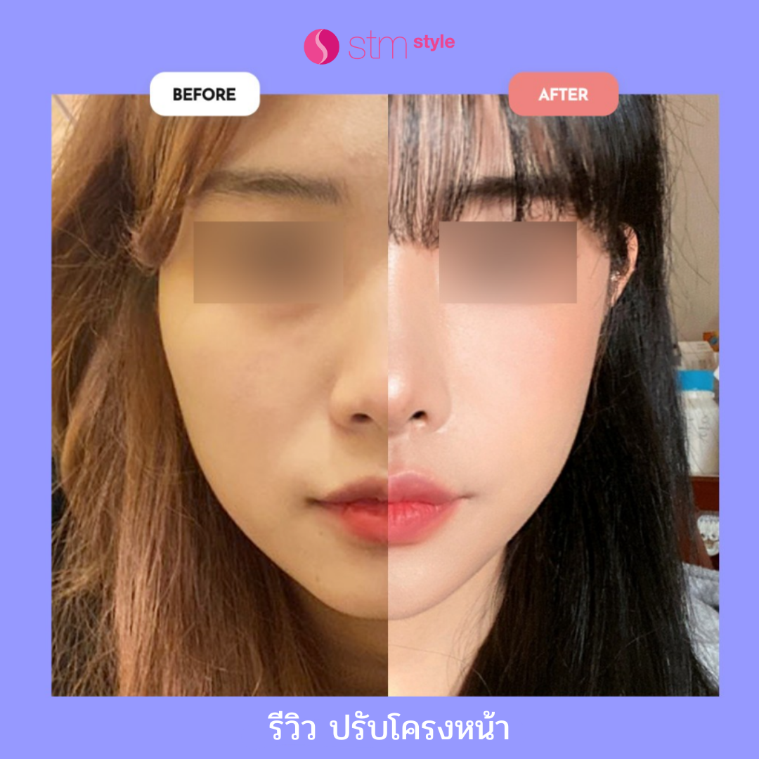 AB Plastic Surgery / facial contouring surgery STM Style