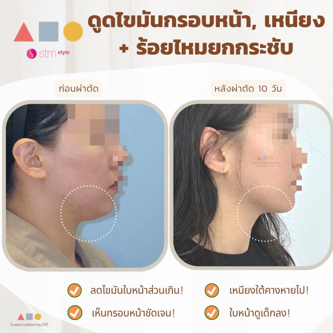 ดูดไขมันกรอบหน้า ร้อยไหมยกกระชับโรงพยาบาล 345 ดูดไขมันเหนียงเกาหลี ร้อยไหมยกกระชับ ยกกระชับเกาหลี STMstyle เอเจนซี่ศัลยกรรมเกาหลี
