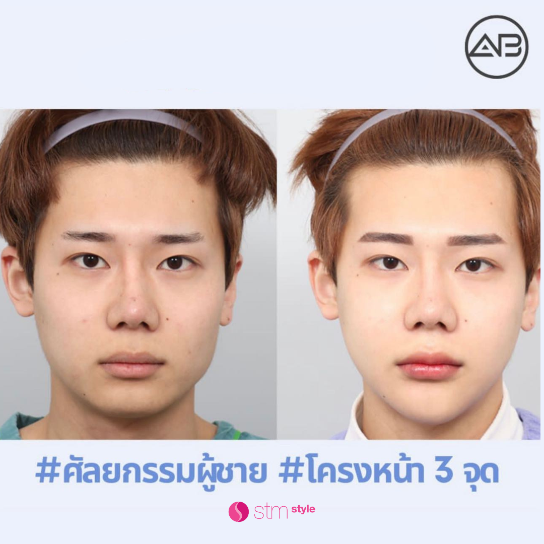 ศัลยกรรมปรับโครงหน้าโรงพยาบาล AB ปรับโครงหน้าผู้ชาย ศัลยกรรมโครงหน้าเกาหลี ปรับโครงหน้า3จุด โหนกแก้ม กราม คาง STMstyleเอเจนซี่ศัลยกรรมเกาหลี