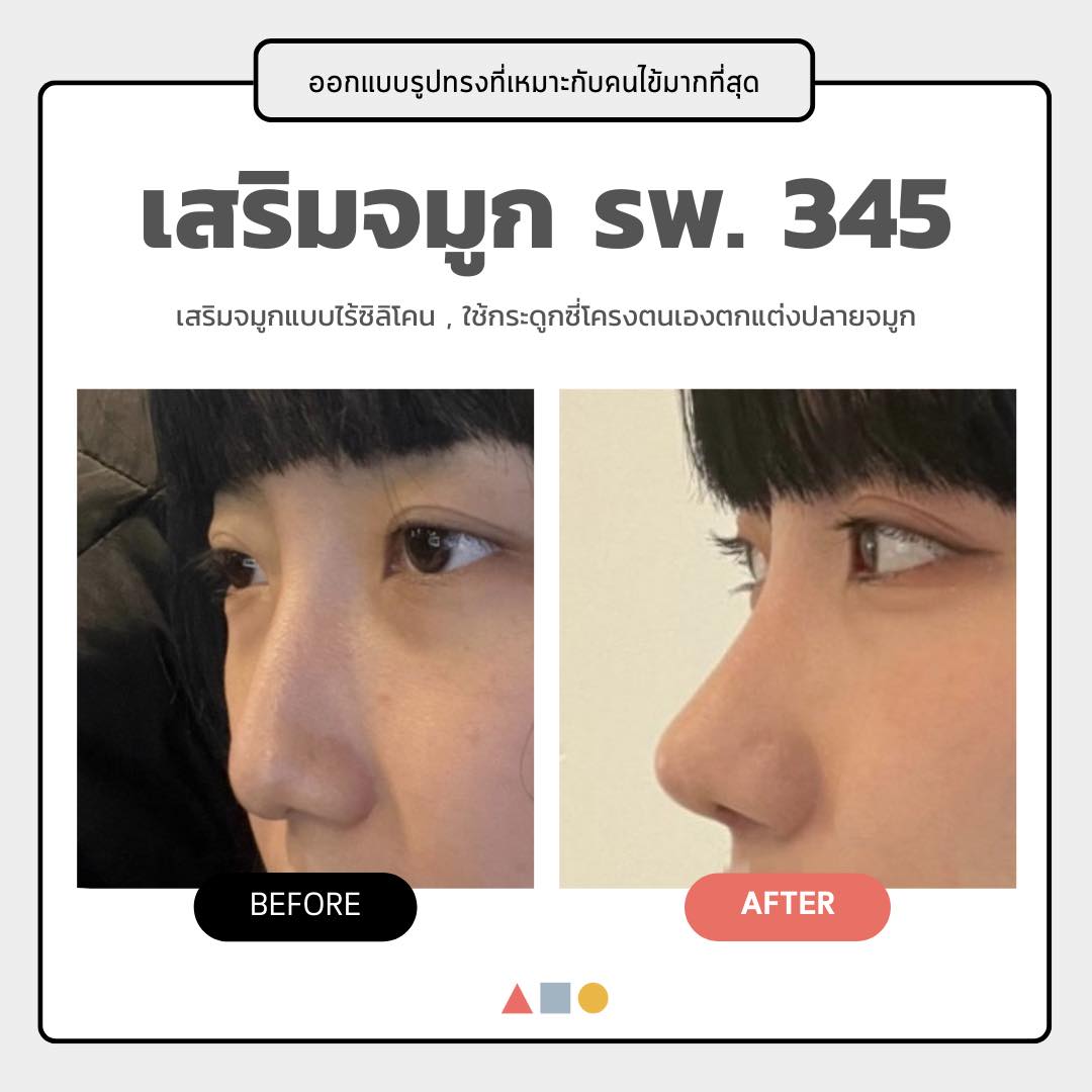 ศัลยกรรมจมูกโรงพยาบาล 345 รีวิวเสริมจมูกเกาหลี ศัลยกรรมจมูกเกาหลี รีวิวศัลยกรรมเกาหลี STMstyle เอเจนซี่ศัลยกรรมเกาหลี รีวิวทำจมูกเกาหลี