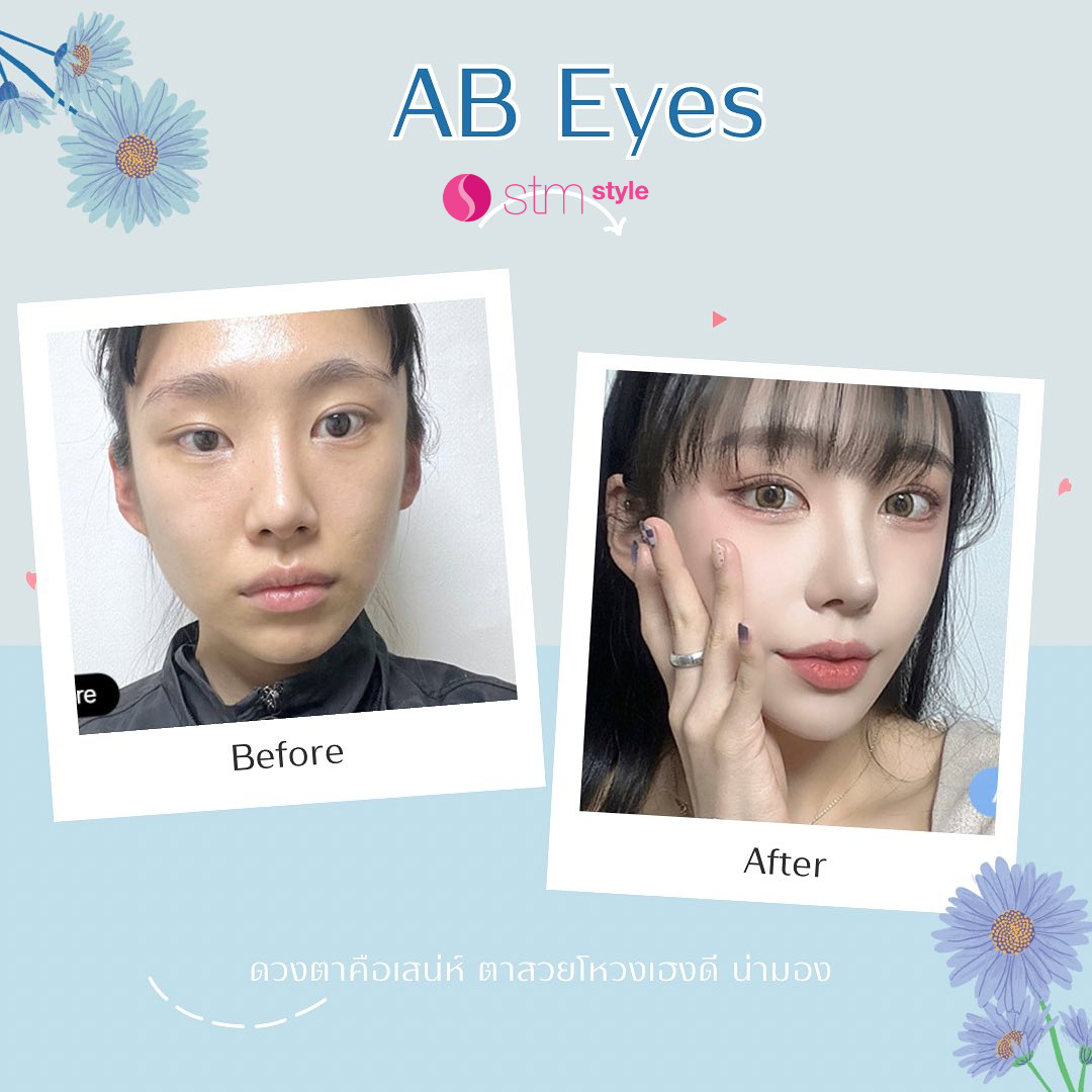 ศัลยกรรมตาโรงพยาบาล AB รีวิวศัลยกรรมตาเกาหลี ตาสองชั้นเกาหลี แก้ตาเกาหลี STMstyle เอเจนซี่ศัลยกรรมเกาหลี รีวิวแก้ตา ทำตา2ชั้นเกาหลี