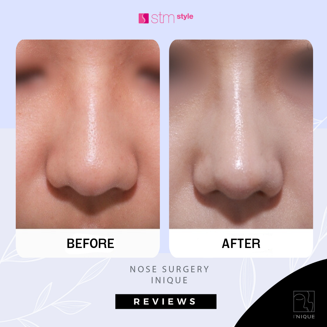 ศัลยกรรมจมูกโรงพยาบาลไอนีค INIQUE รีวิวเสริมจมูกเกาหลี ศัลยกรรมจมูกเกาหลี รีวิวศัลยกรรมเกาหลี STMstyle เอเจนซี่ศัลยกรรมเกาหลี ทำจมูกเกาหลี