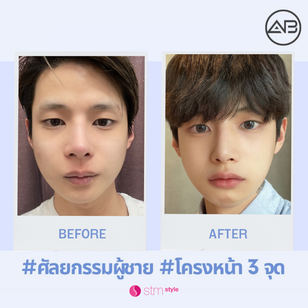 ศัลยกรรมโครงหน้าโรงพยาบาล AB รีวิวปรับโครงหน้าเกาหลี ศัลยกรรมโครงหน้าผู้ชาย รีวิวศัลยกรรมโครงหน้า STMstyle เอเจนซี่ศัลยกรรมเกาหลี