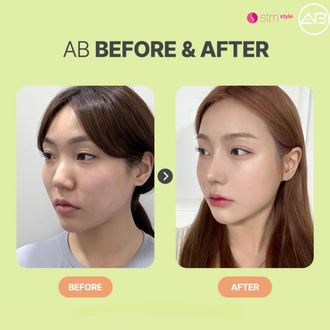 ศัลยกรรมจมูกโรงพยาบาล AB รีวิวเสริมจมูกเกาหลี ศัลยกรรมจมูกเกาหลี รีวิวศัลยกรรมเกาหลี STMstyle เอเจนซี่ศัลยกรรมเกาหลี รีวิวทำจมูกเกาหลี