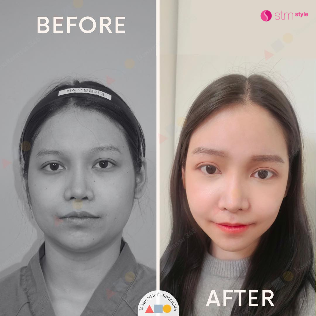 ศัลยกรรมโครงหน้าโรงพยาบาล 345 รีวิวปรับโครงหน้าเกาหลี ศัลยกรรมโครงหน้าเกาหลี STMstyle เอเจนซี่ศัลยกรรม ปรับโครงหน้า3จุด โหนกแก้ม กราม คาง