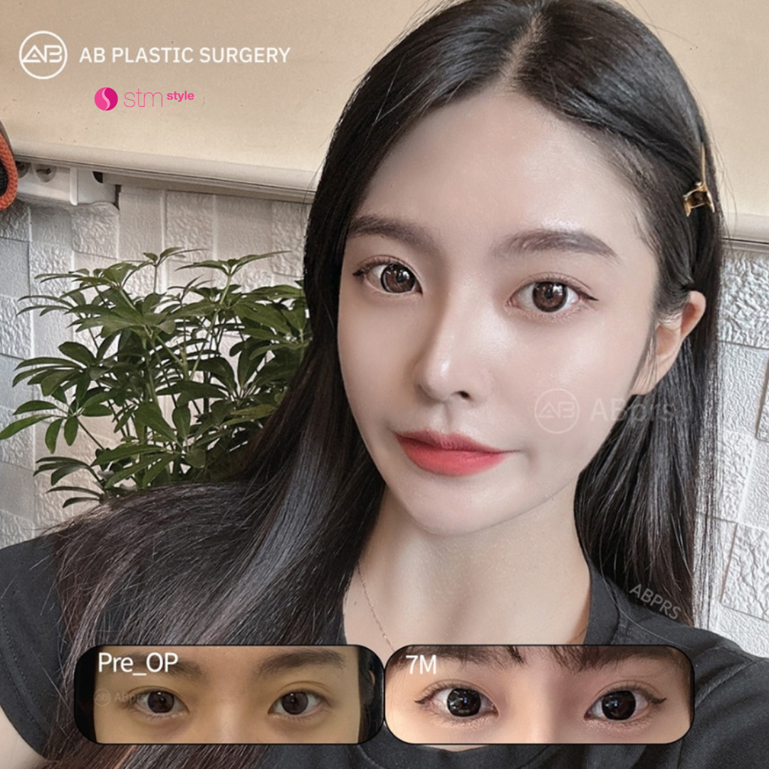 ศัลยกรรมตาโรงพยาบาล AB รีวิวศัลยกรรมตาเกาหลี รีวิวตาสองชั้นเกาหลี แก้ตาเกาหลี STMstyle เอเจนซี่ศัลยกรรมเกาหลี รีวิวแก้ตา ทำตาสองชั้นเกาหลี