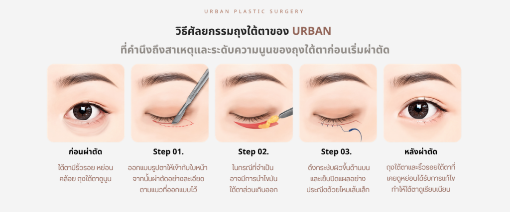 วิธี ศัลยกรรมถุงใต้ตา