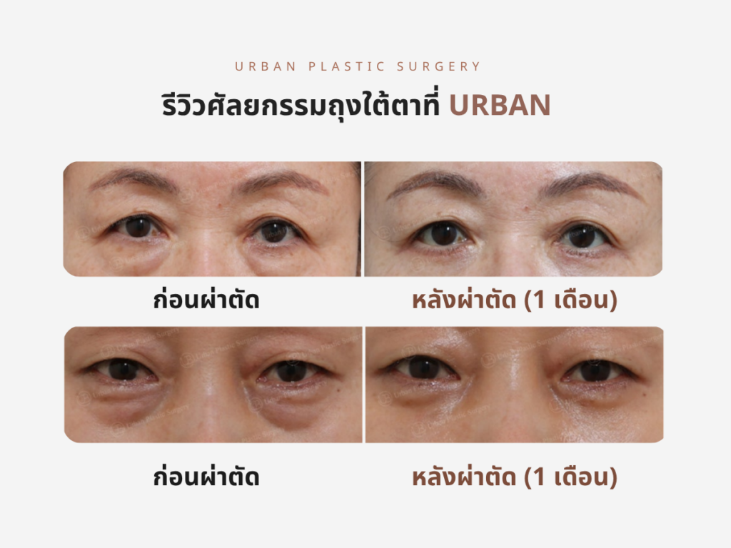รีวิว ศัลยกรรมถุงใต้ตา จากเคสจริง 1
