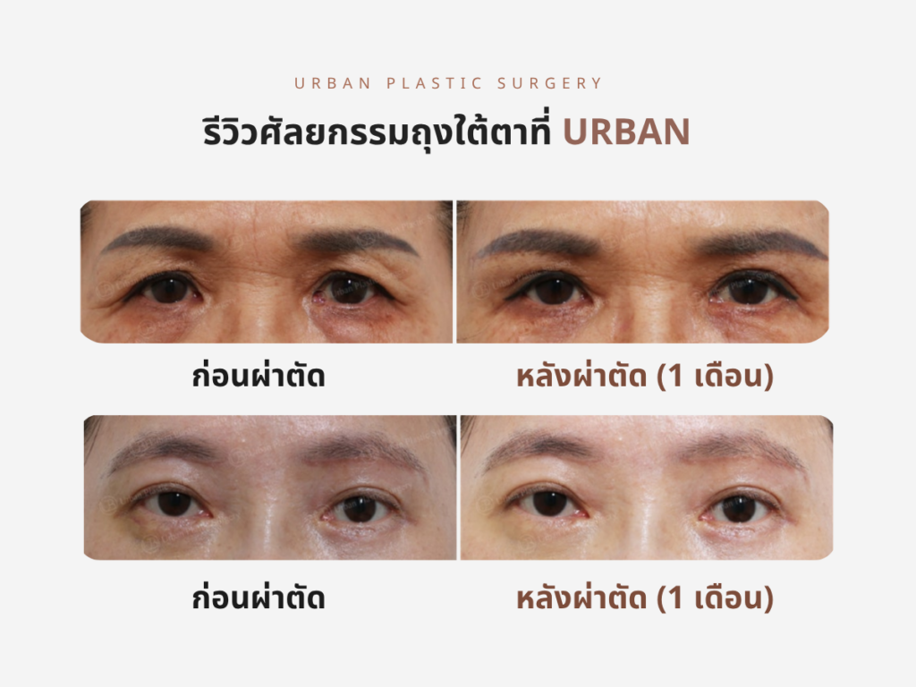 รีวิว ศัลยกรรมถุงใต้ตา 2