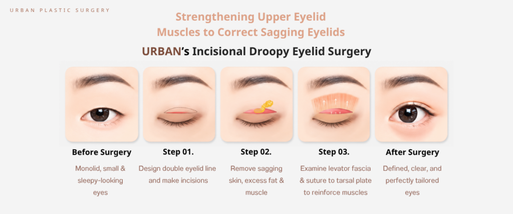 Choosing the Right Hospital for Eyelid Surgery Is an Important Decision