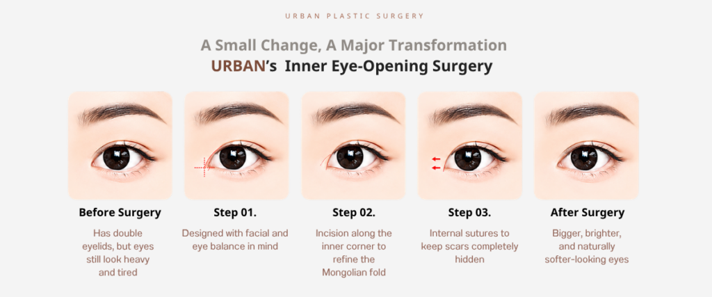 Korean Canthoplasty: 1.  Medial Epicanthoplasty (Inner Corner Eye Surgery) 