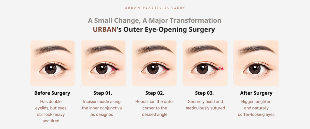 Korean Canthoplasty: 2. Lateral Canthoplasty (Outer Corner Eye Surgery) 