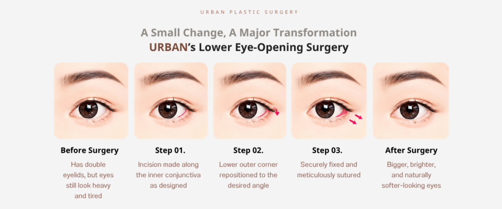 Korean Canthoplasty: 3.  Lower Canthoplasty (Lowering Canthoplasty)