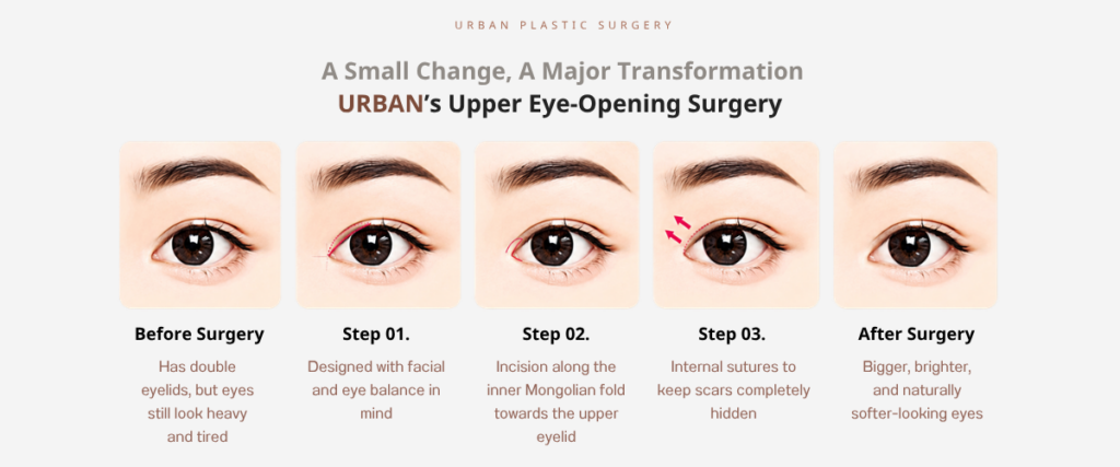 4. Upper Canthoplasty (Upper Eye Corner Surgery)
