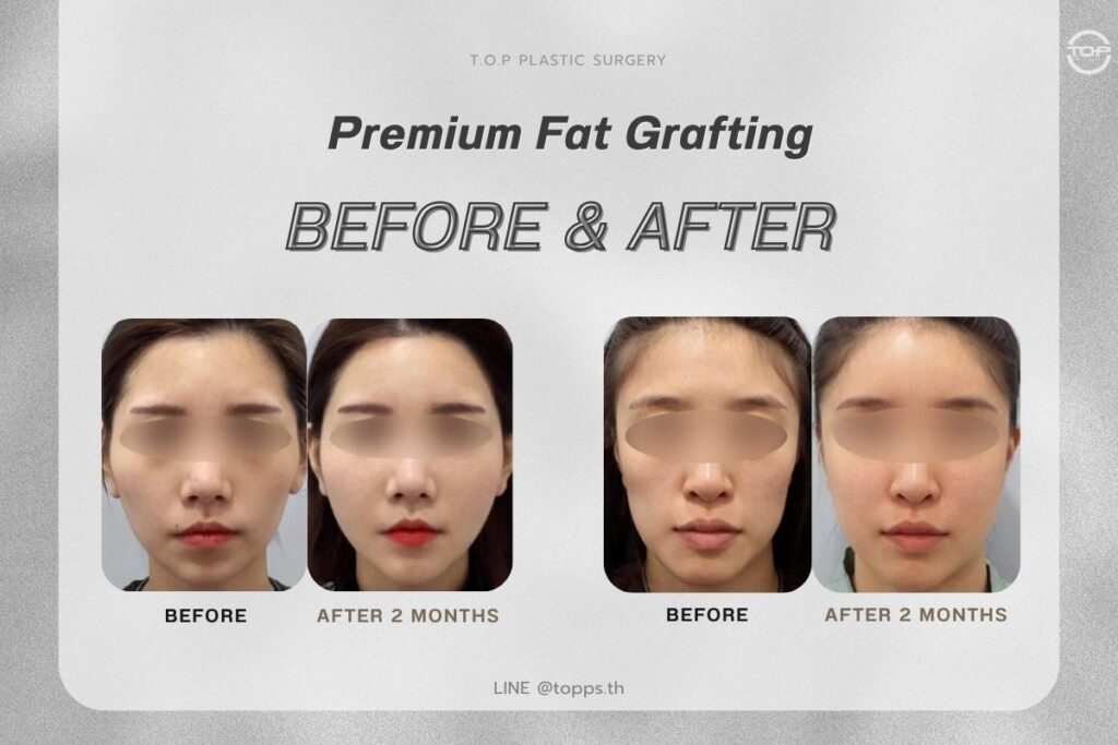 Results You Can See and Feel: Softer, More Defined Facial Contours
