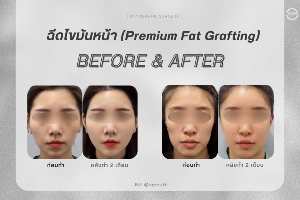 ผลลัพธ์ที่คุณสัมผัสได้ ปรับรูปหน้าให้ละมุนมีมิติ