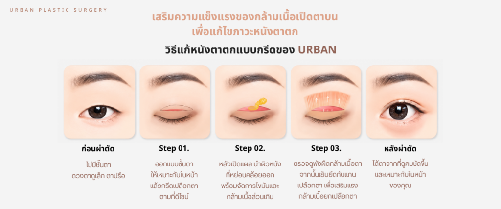 วิธีแก้หนังตาตกแบบกรีดของเออร์บัน