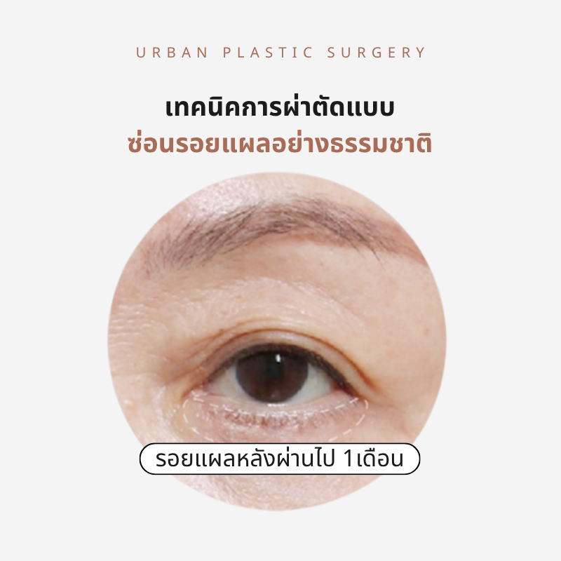 เทคนิคการผ่าตัดแบบซ่อนรอยแผล ในระหว่าง ศัลยกรรมถุงใต้ตา