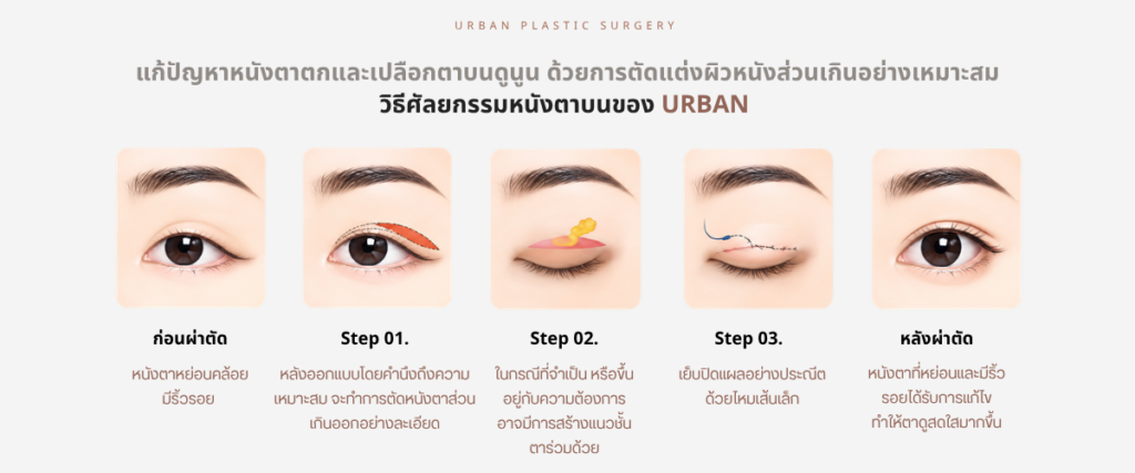 การออกแบบ ศัลยกรรมหนังตาบน