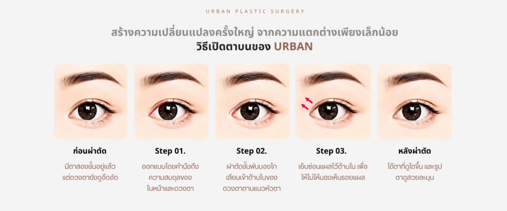 ศัลยกรรมเปิดตา ส่วนตาบน
