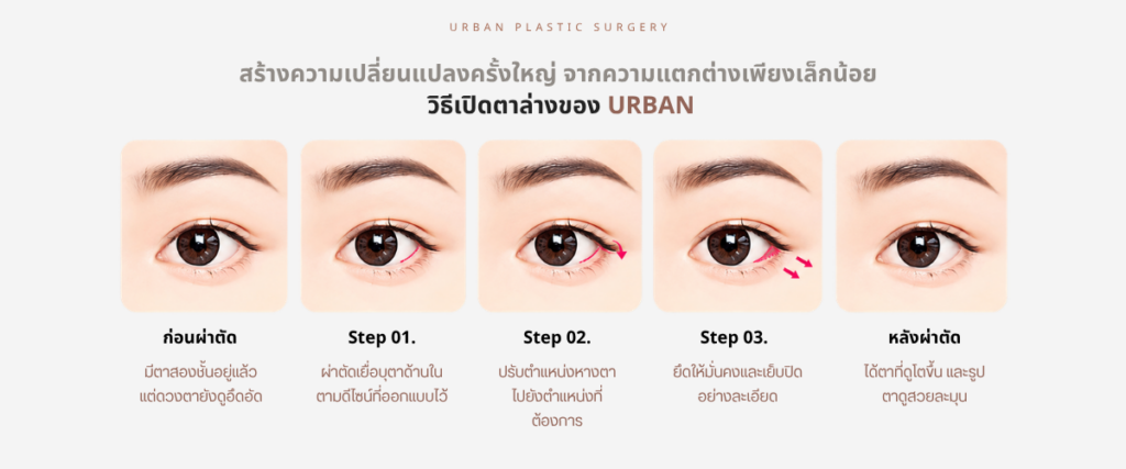 ศัลยกรรมเปิดตาล่าง