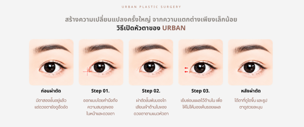 ศัลยกรรมเปิดตา ส่วนหัวตา