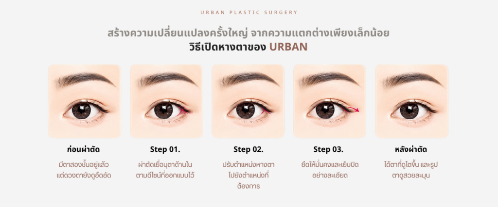 ศัลยกรรมเปิดตา ส่วนหางตา