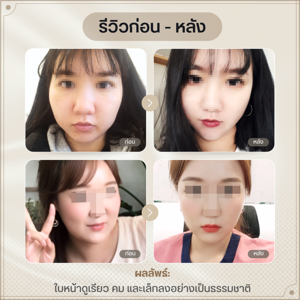 ผลลัพธ์หลังทำ: ใบหน้าเรียว คม และมีมิติมากขึ้น หลังผ่าตัด ไขมันแก้มลึก