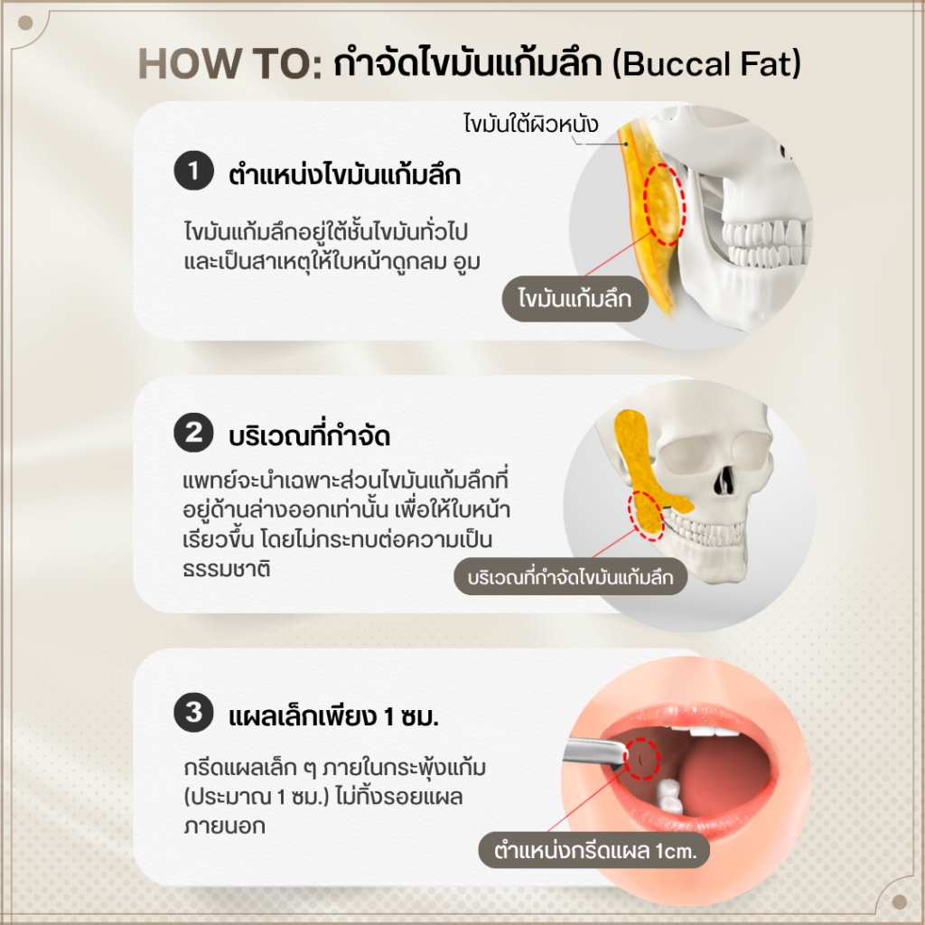 How To: บอกลาแก้มป่องด้วย "การผ่าตัดไขมันกระพุ้งแก้ม"