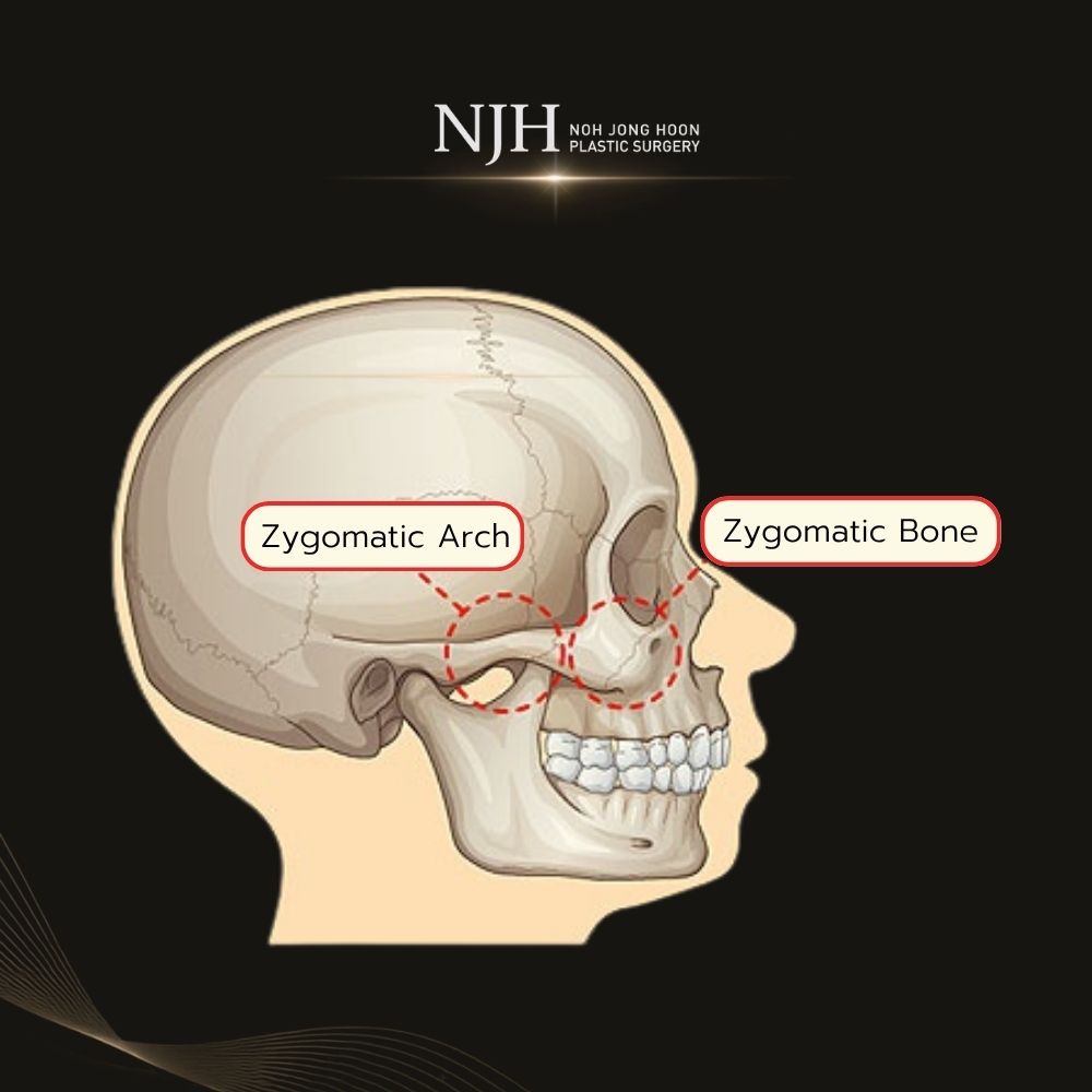 Why Are Precise Bone Cutting and Secure Fixation Important in Cheekbone Reduction Surgery?