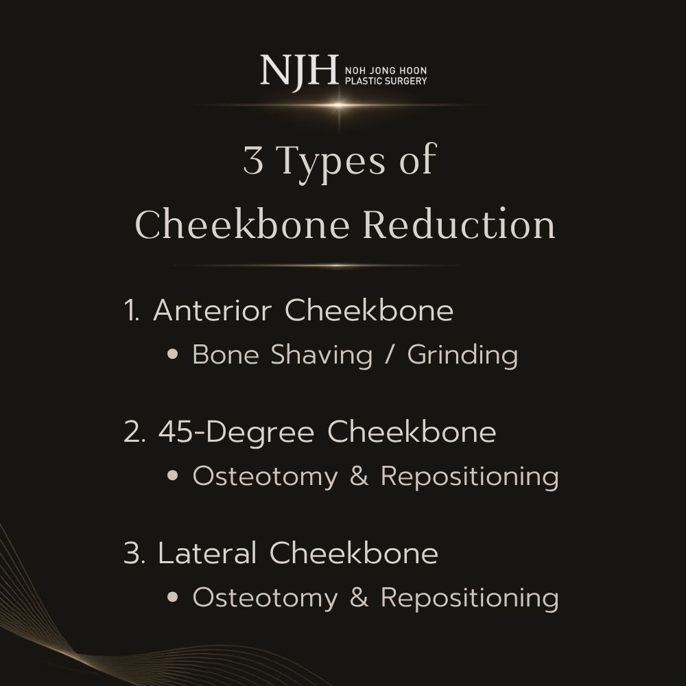 3 Main Types of Cheekbone Reduction Surgery (Zygoma Reduction Techniques)