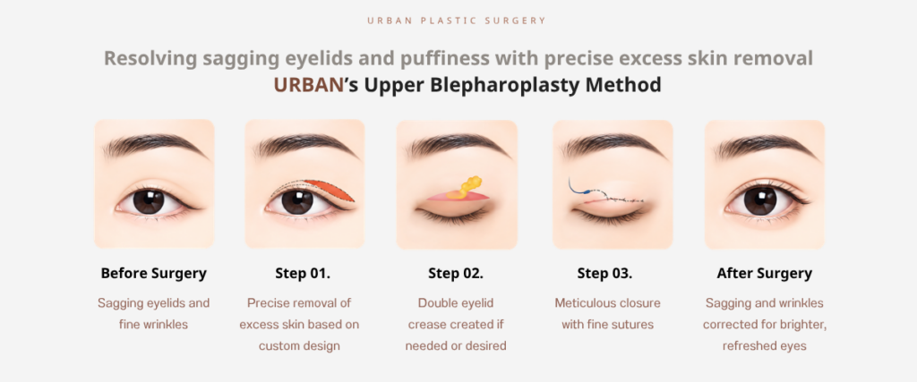 Customized Upper Eyelid Surgery Design and Planning