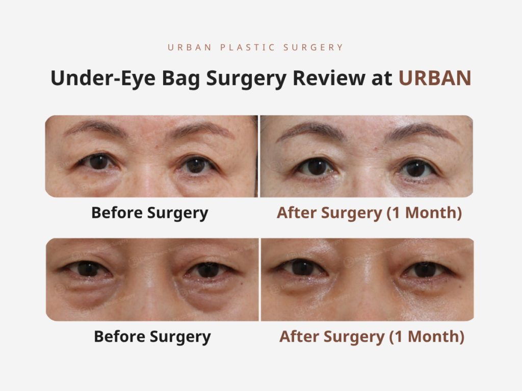 Real Case Review 1: Under-Eye Bag Surgery (Lower Blepharoplasty)
 Under-Eye Bag Surgery