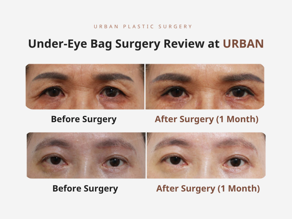 Real Case Review 2: Under-Eye Bag Surgery (Lower Blepharoplasty)