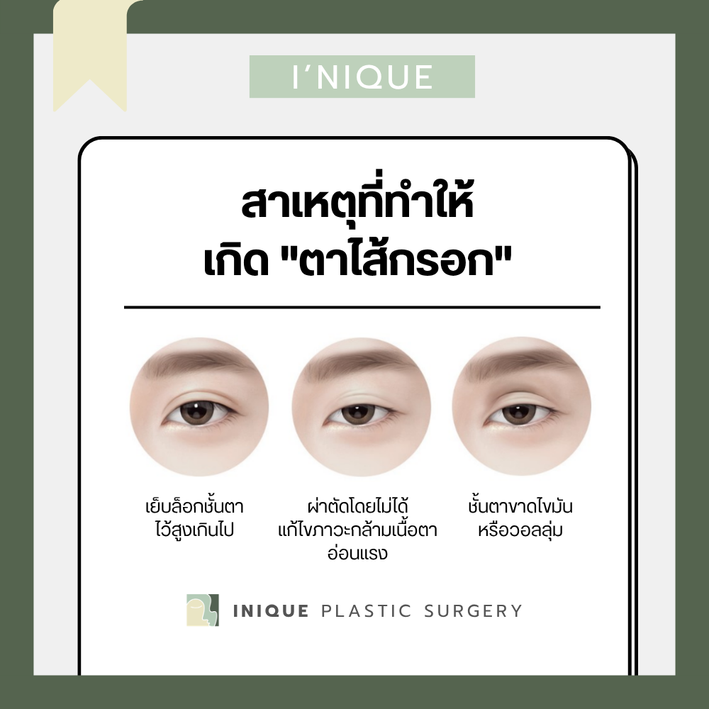 สาเหตุหลักที่ทำให้เกิดภาวะ "ตาไส้กรอก" จนต้อง แก้ตาไส้กรอก