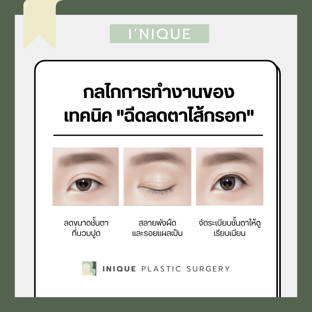 กลไกการทำงานของ "ฉีดลดตาไส้กรอก" ที่ iNique 
