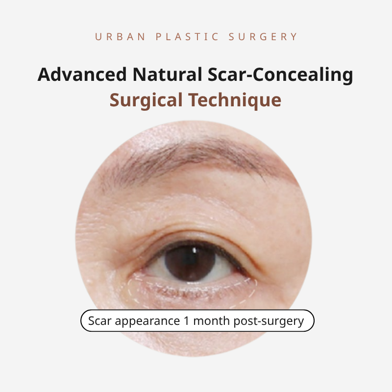 Hidden-Scar Technique During Under-Eye Bag Surgery (Lower Blepharoplasty)

Under-Eye Bag Surgery