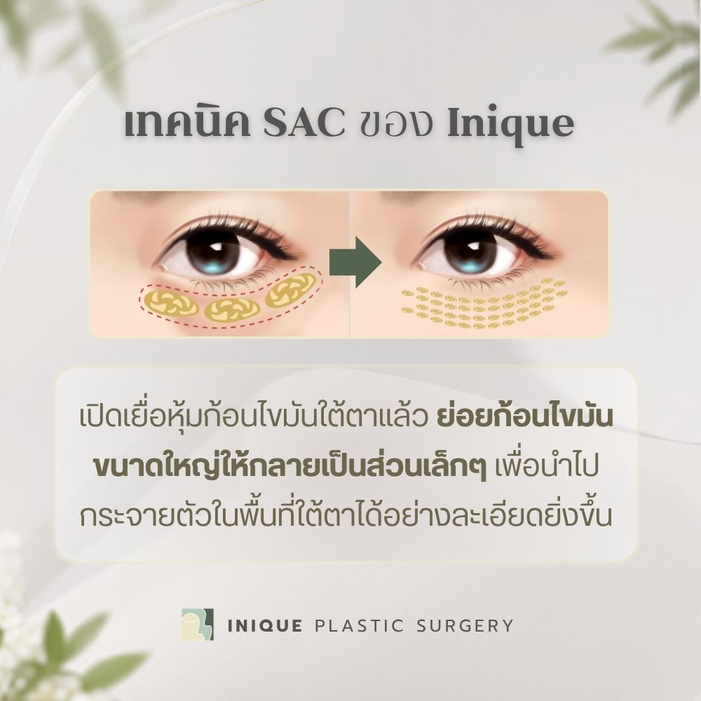 เทคนิค SAC ของ Inique ต่างจากการตัดไขมันใต้ตาทั่วไปอย่างไร? ช่วยลด ใต้ตานูน ร่องตาลึก ได้ยังไง